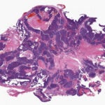 photo of breast cancer tumor cross section