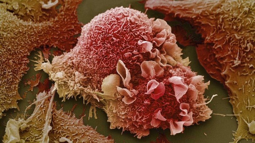 Image of lung cancer cells