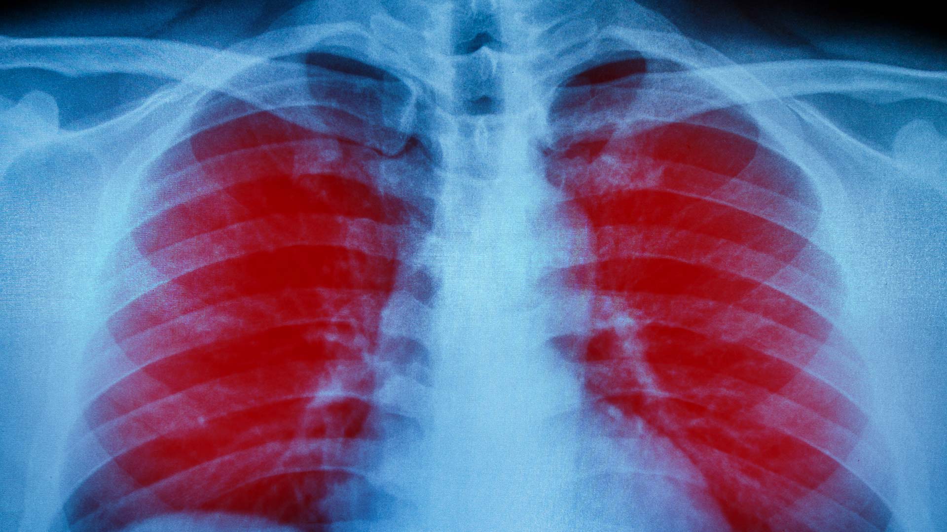 X-Ray Scan of Human Chest