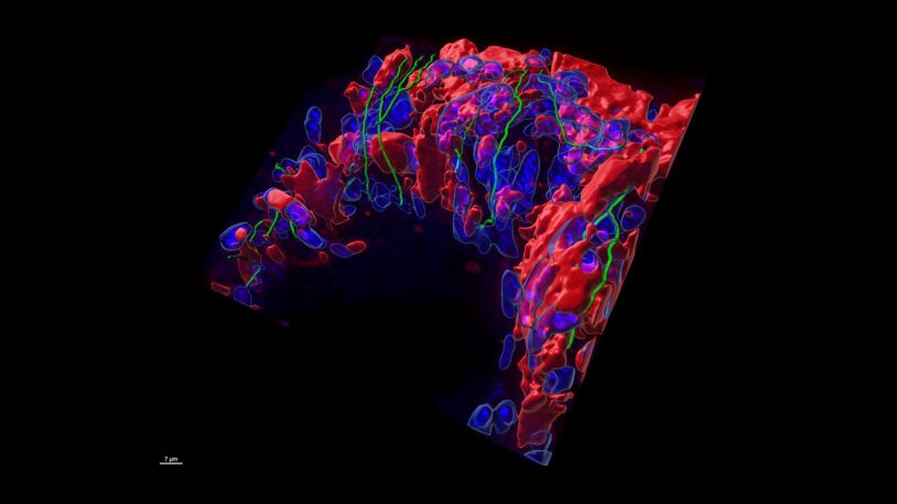 Image of metastatic liver with prostate tumor cells