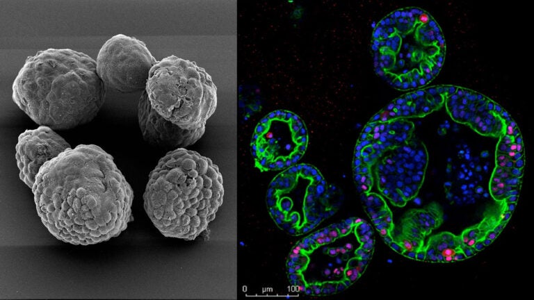 Image of mouse and human pancreas tumor organoids