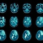 Image of glioblastoma patient brain MRI