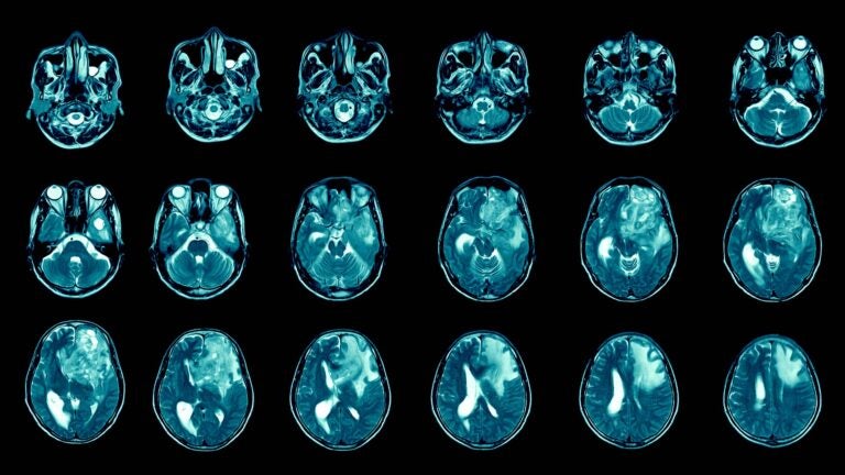 image of glioblastoma patient brain MRI