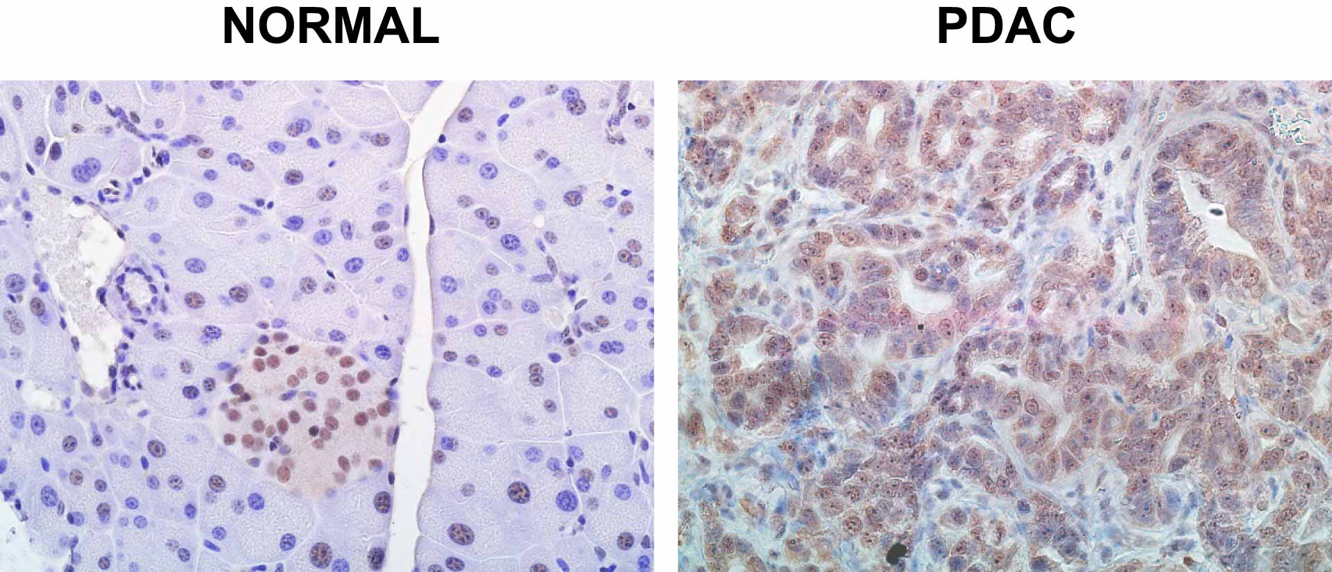 Image of normal and PDAC pancreas cell comparison