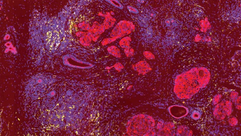 Image of breast cancer tumor and metastatic lymph nodes