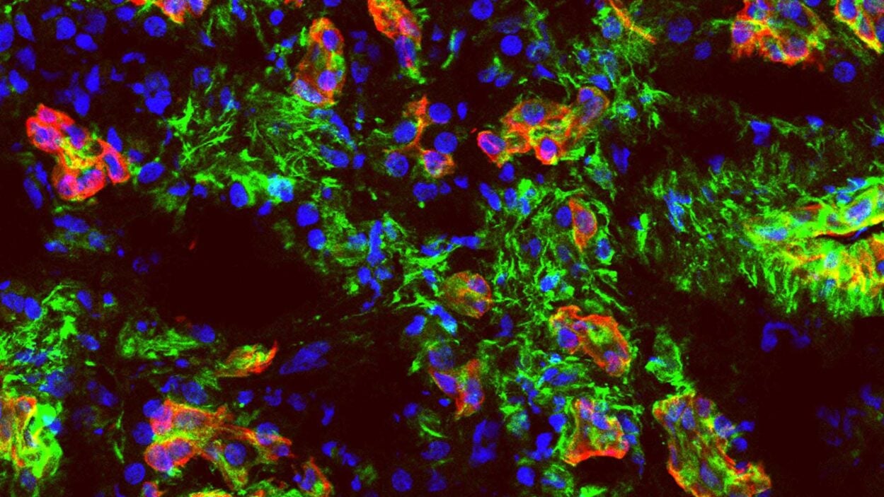 Image of pancreatic cancer cells