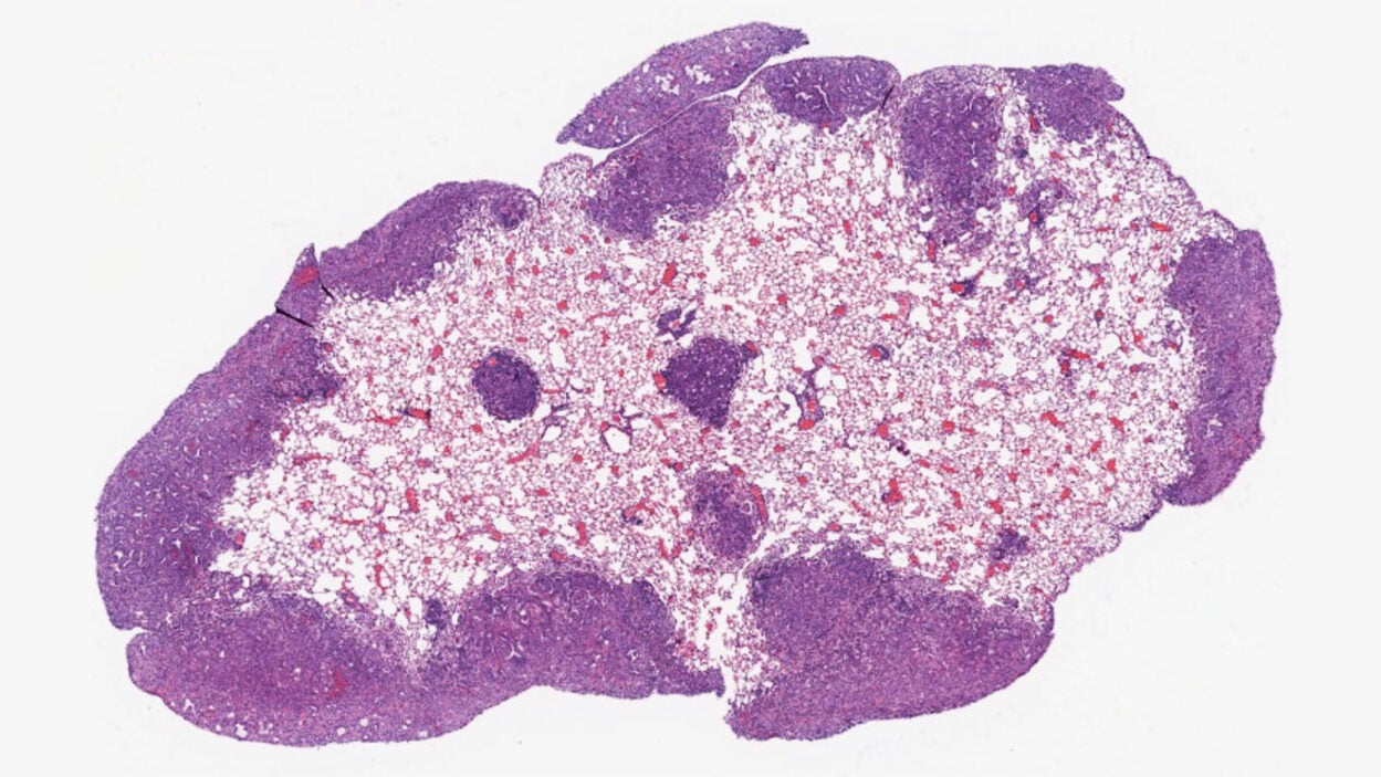 Pancreatic ductal adenocarcinoma