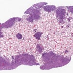 Pancreatic ductal adenocarcinoma