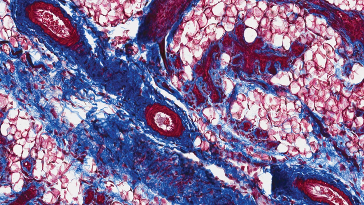 Image of Mice with UTI breast tissue collagen deposits