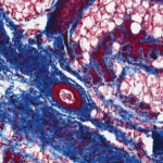 Image of Mice with UTI breast tissue collagen deposits