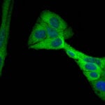 image of PHGDH enzyme in metabolic pathway in breast cancer cells