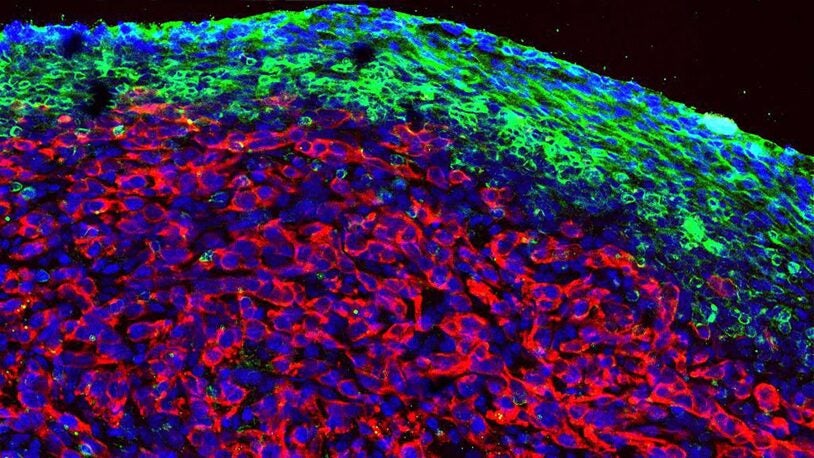 image of Pancreatic ductal adenocarcinoma