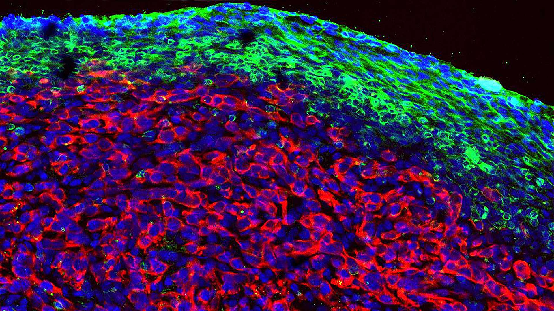 image of Pancreatic ductal adenocarcinoma