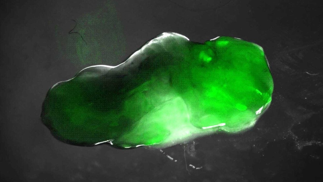 image of prostate tumor