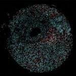 image of nuclear speckles in renal cancer