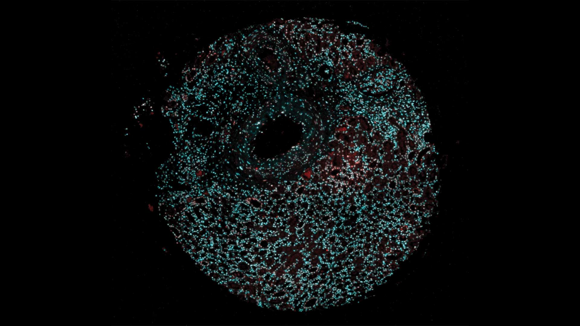 image of nuclear speckles in renal cancer