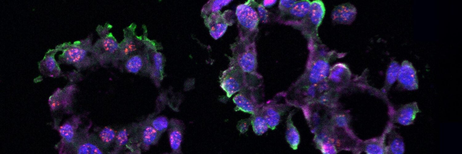 Image of a triple-negative breast cancer organoid
