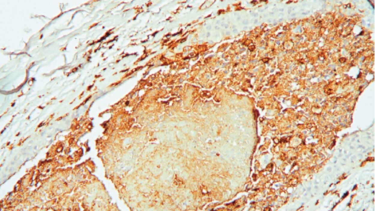 Image of a tumor from a patient with invasive ductal breast carcinoma