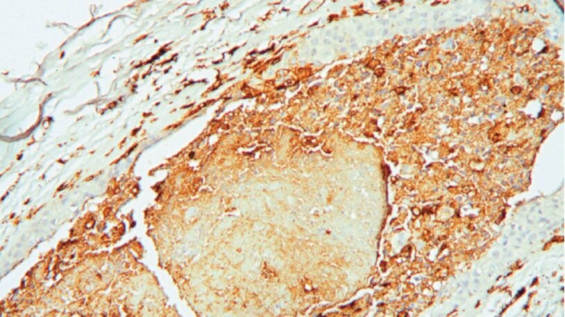 Image of a tumor from a patient with invasive ductal breast carcinoma