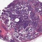 Image of a mammary tumor from a BPTF knockout mouse