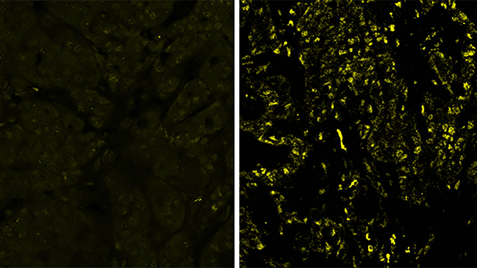 Image of tumors with different levels of BPTF protein