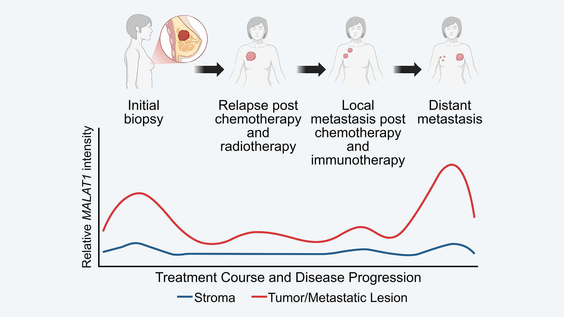 Diagram showing cancer progression, treatment stages, and graph of MALAT1 intensity in stroma and metastatic lesions.