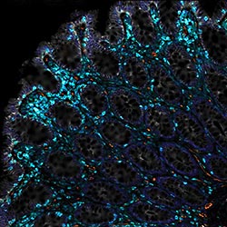 Gut health à la CAR T